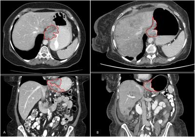 Combination of clinical, radiomic, and “delta” radiomic features in survival prediction of metastatic gastroesophageal adenocarcinoma